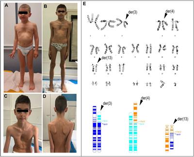 Case Report: Decrypting an interchromosomal insertion associated with Marfan’s syndrome: how optical genome mapping emphasizes the morbid burden of copy-neutral variants